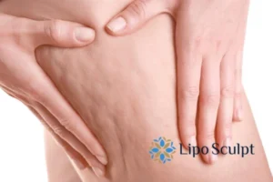 CoolSculpting for Legs: The Innovative Approach to Redefining Your Legs 5 Start your journey today book your coolsculpting treatment Leicester online today!